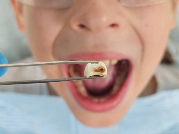 Best Emergency Treatment for Toothache in Cayce, SC