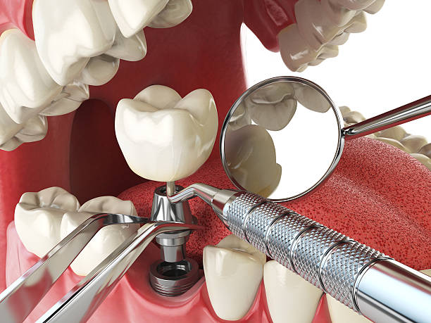 Best Emergency Tooth Extraction in Cayce, SC